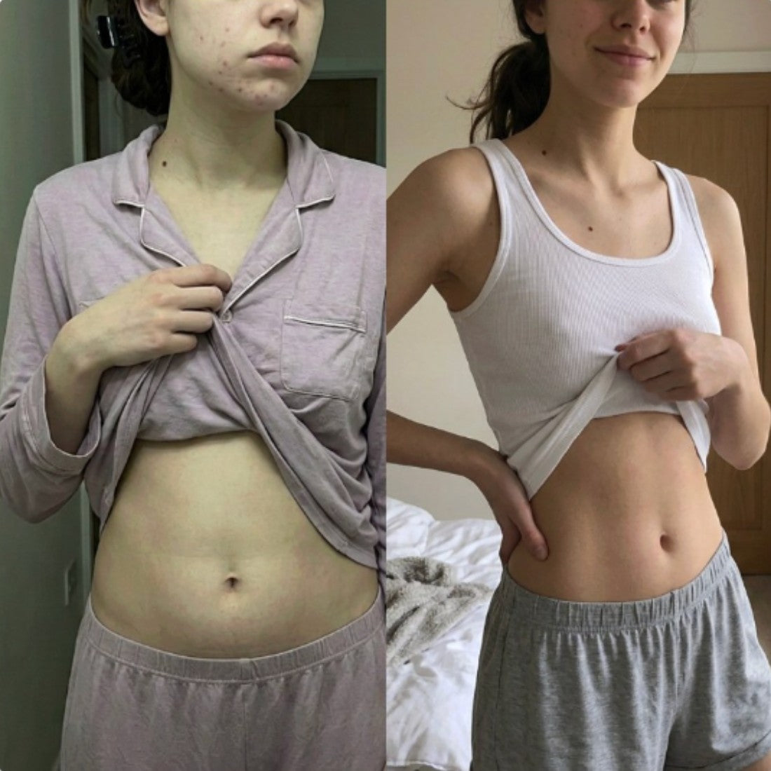 Before and after photos of a woman lifting her top, showing a bloated stomach and breakouts on the left and a flatter stomach with clear skin on the right