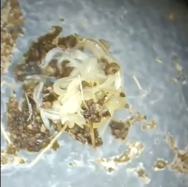 A cluster of pale parasitic worms passed in a stool sample