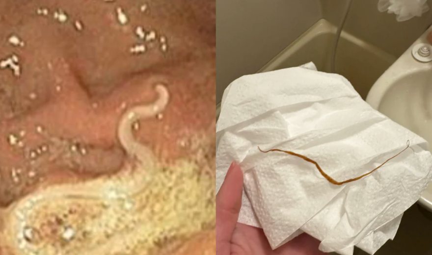Endoscopy image showing a worm on the gut wall, and a worm passed after the cleanse