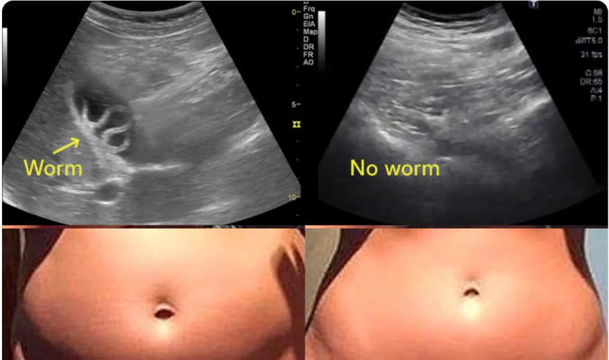 Ultrasound before and after, and a stomach before and after the cleanse