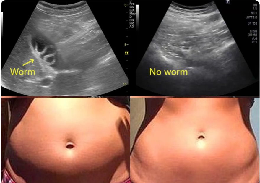 Ultrasound before and after, and a stomach before and after the cleanse