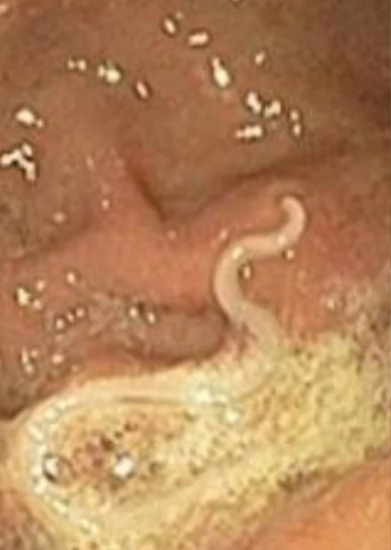Endoscopy showing a parasite on the gut wall