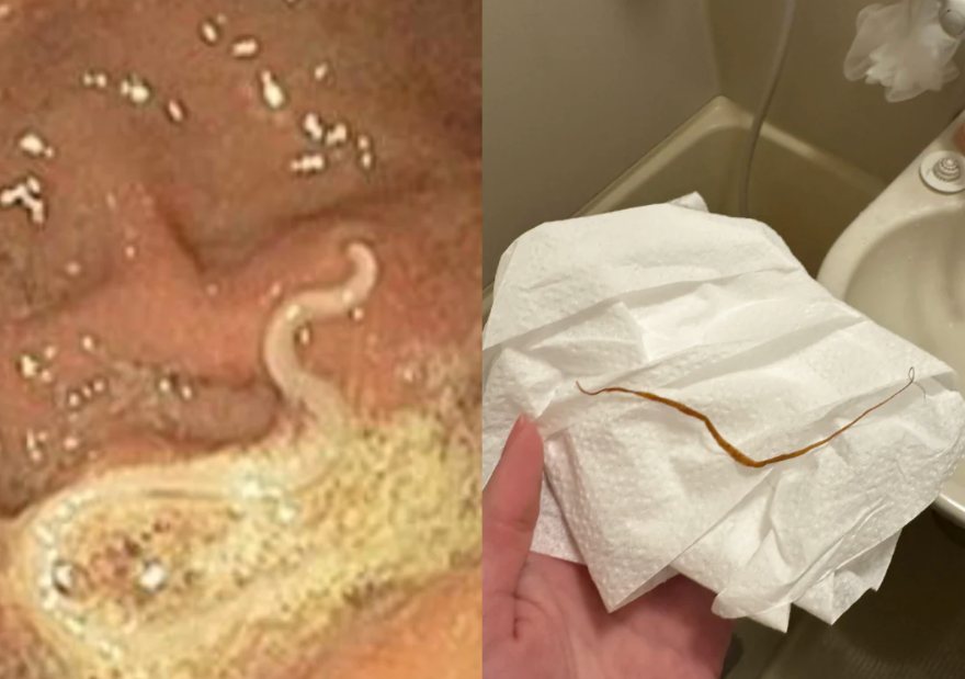 Endoscopy image showing a worm on the gut wall, and a worm passed after the cleanse
