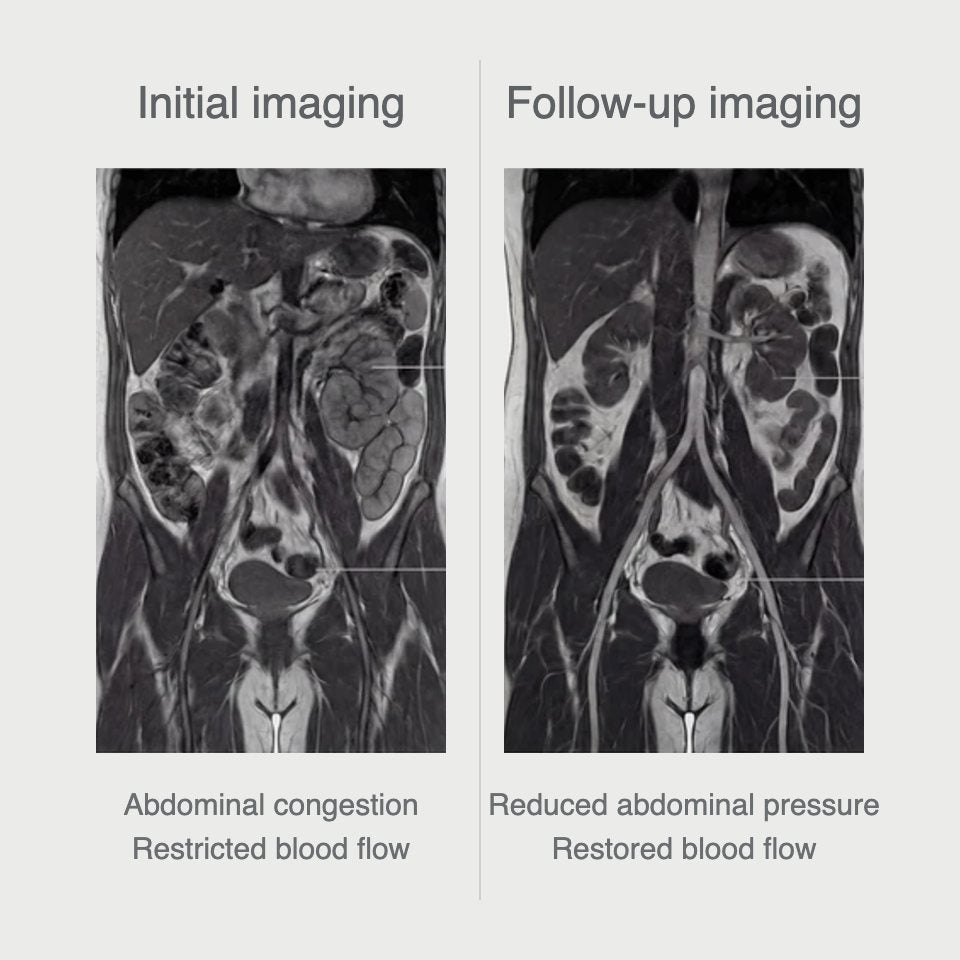 MRI comparison of initial imaging showing abdominal congestion and restricted blood flow next to follow-up imaging showing reduced abdominal pressure and restored blood flow