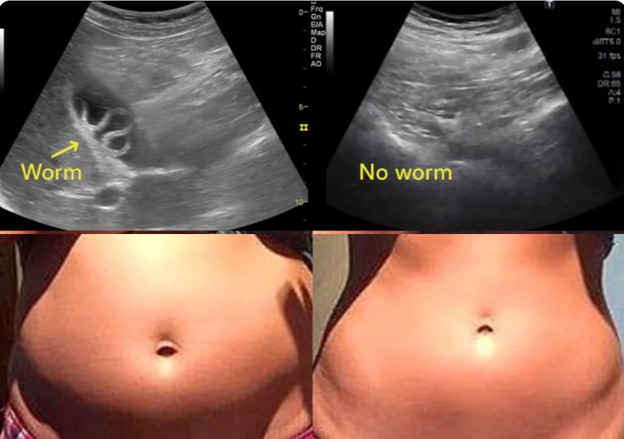 Ultrasound before and after, and a stomach before and after the cleanse