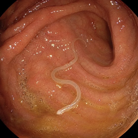 Scope image showing a worm on the gut wall before the cleanse