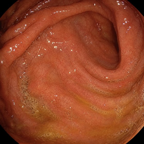 The same stretch of gut wall completely clean after the cleanse