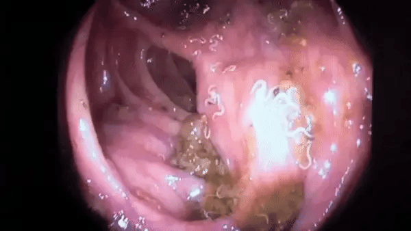 Endoscopy footage of pale parasitic worms moving in the gut