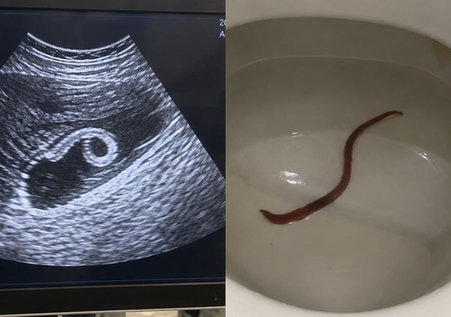 An abdominal scan showing a parasite, and the same parasite passed after the cleanse