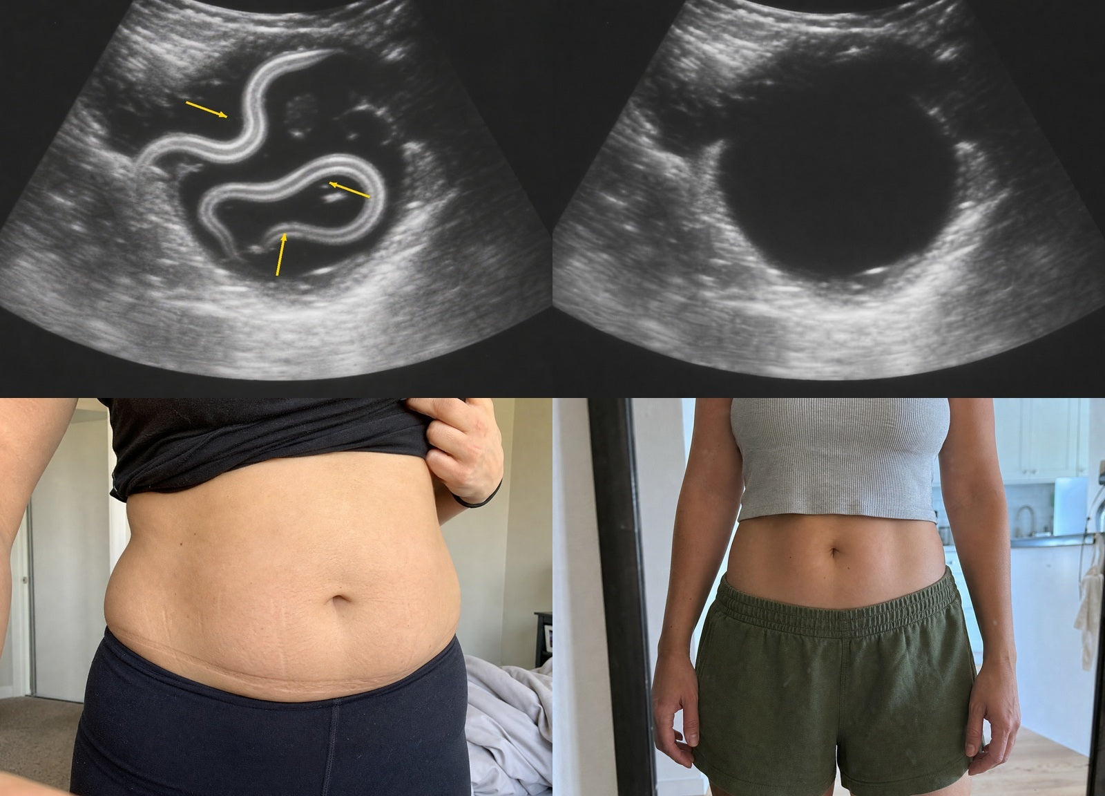Ultrasound before and after, and a stomach before and after the cleanse