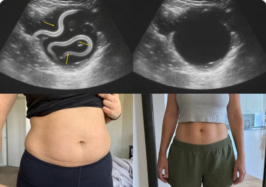 Nadia F. ultrasound before and after, and her stomach before and after the cleanse