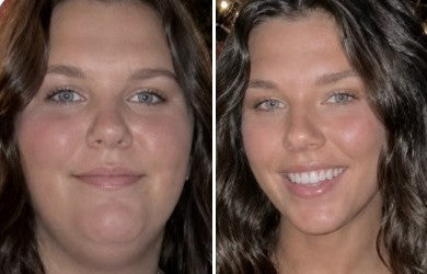 Brittany M. before and after, facial puffiness gone