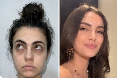 Yasmine K. before and after, dark circles faded