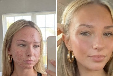 Chloe D. before and after, skin cleared