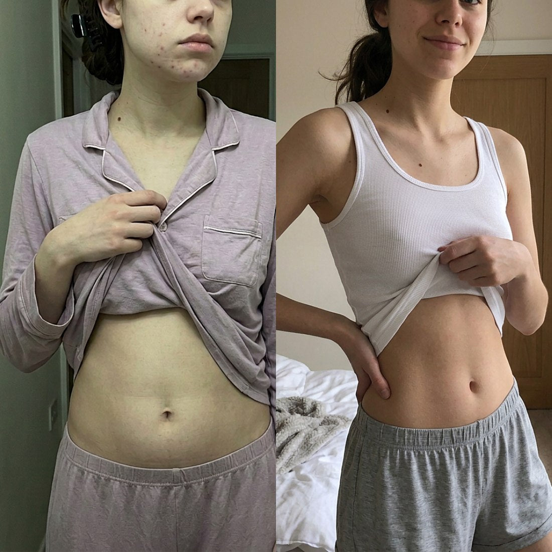 Before and after mirror selfies showing her bloated stomach and breakouts clearing