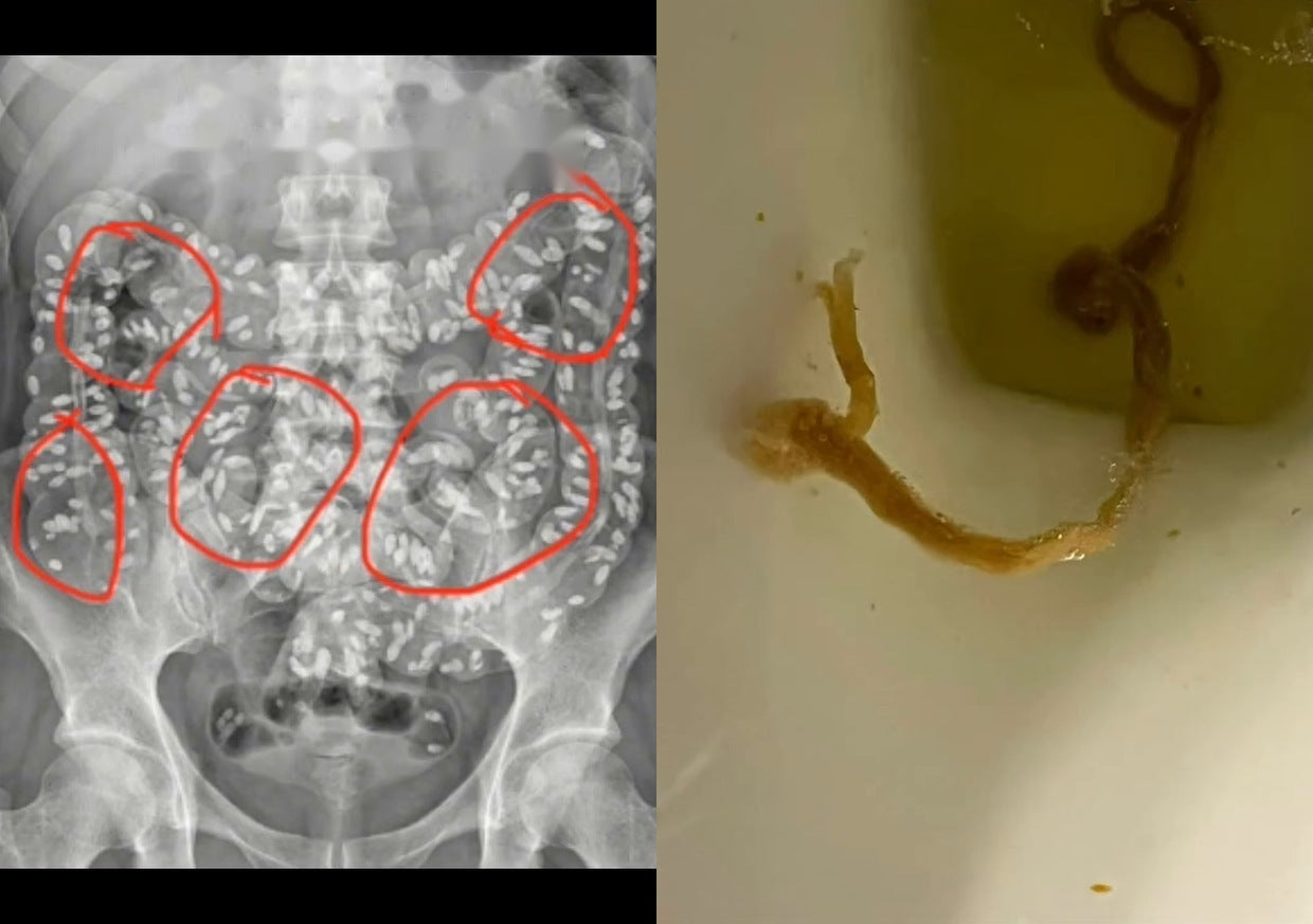 An abdominal X-ray showing parasites, and a parasite passed after the cleanse